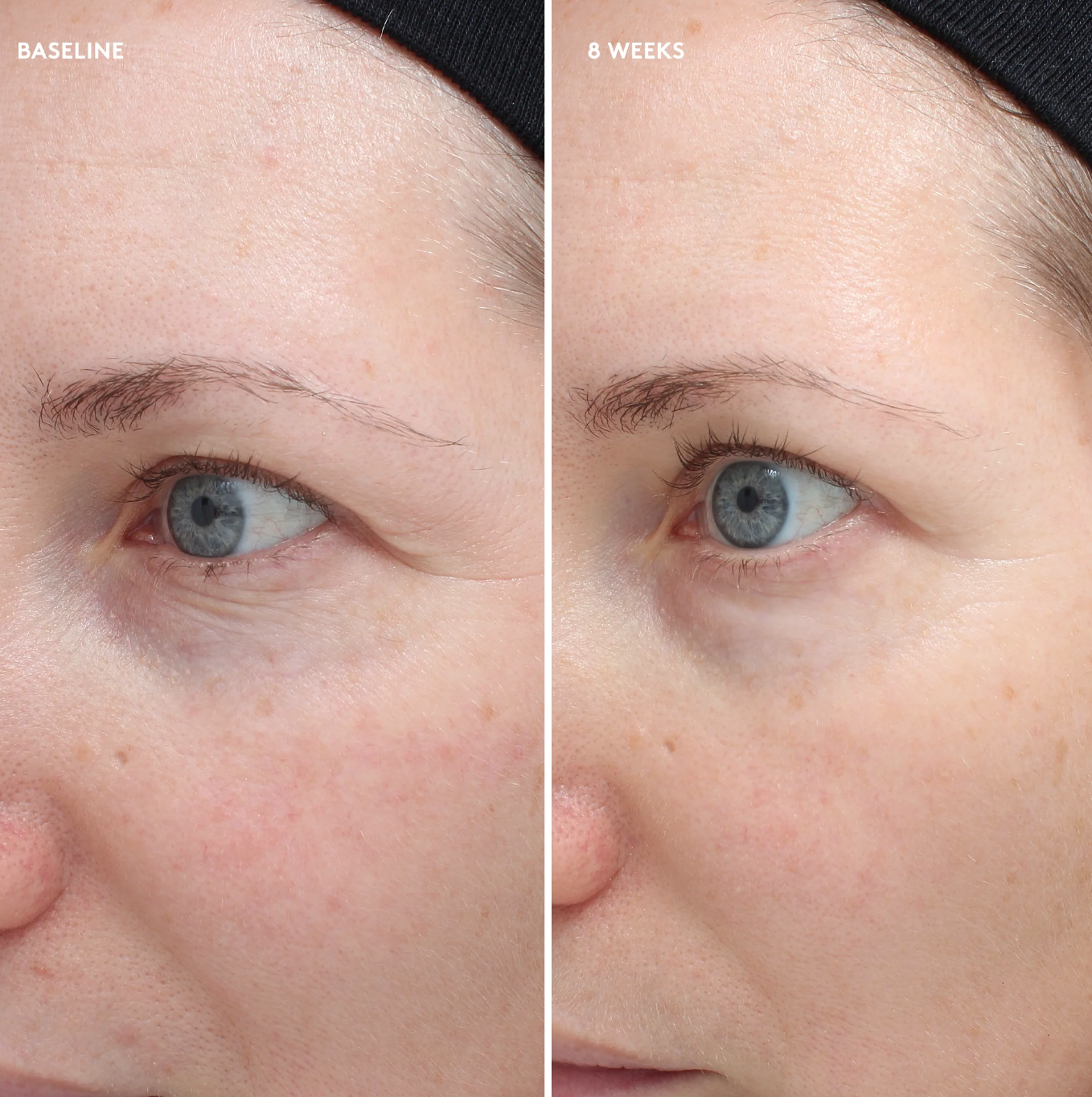 Before and after comparison of a woman's eye area with visible improvement over 6 weeks.