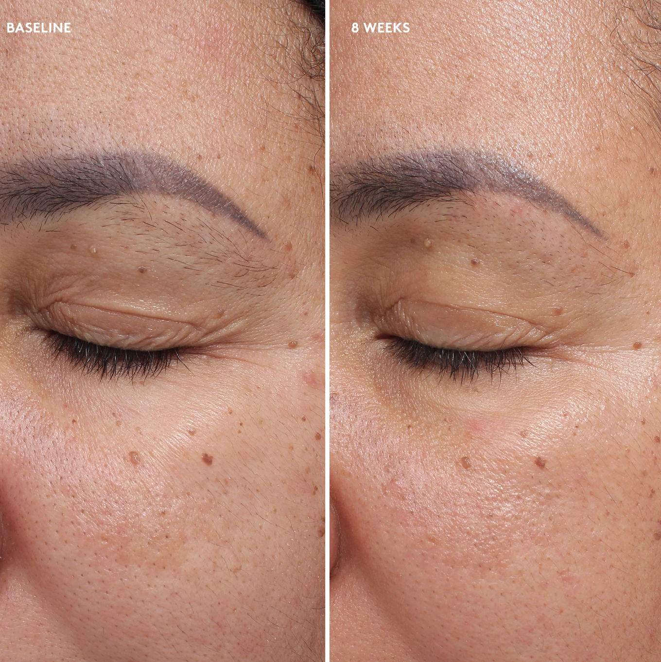 Before and after comparison of eye area skin texture on a person's face.