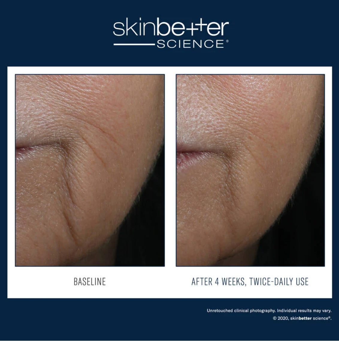 Before and after comparison of skin texture with 'skinbetter science' branding.