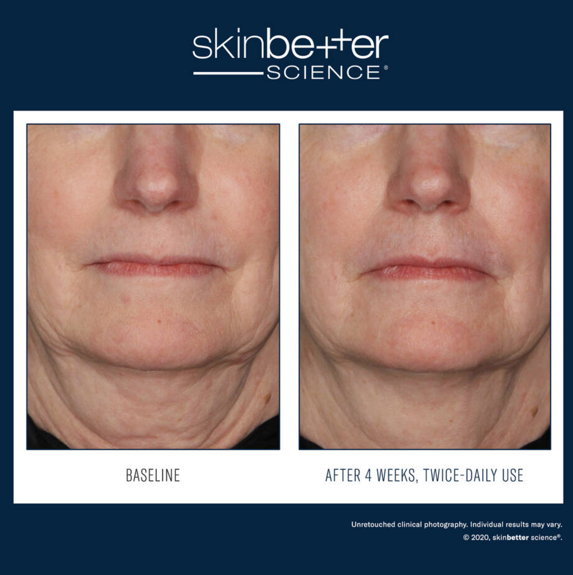 Before and after comparison of skin texture with 'skinbetter science' branding.