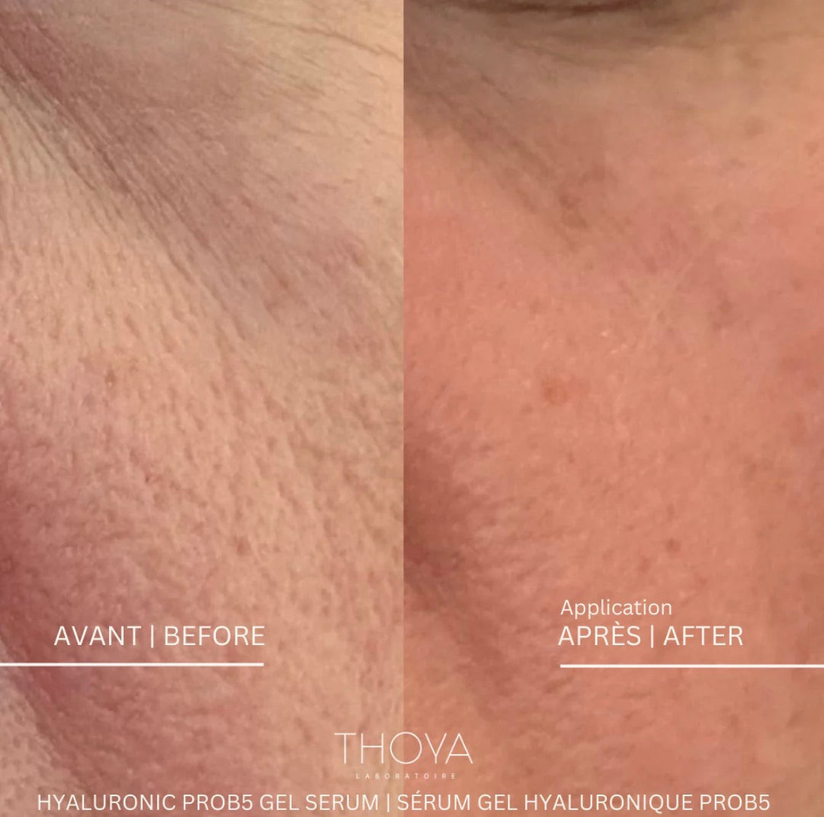 Before and after comparison of skin treatment with Thoya serum gel.