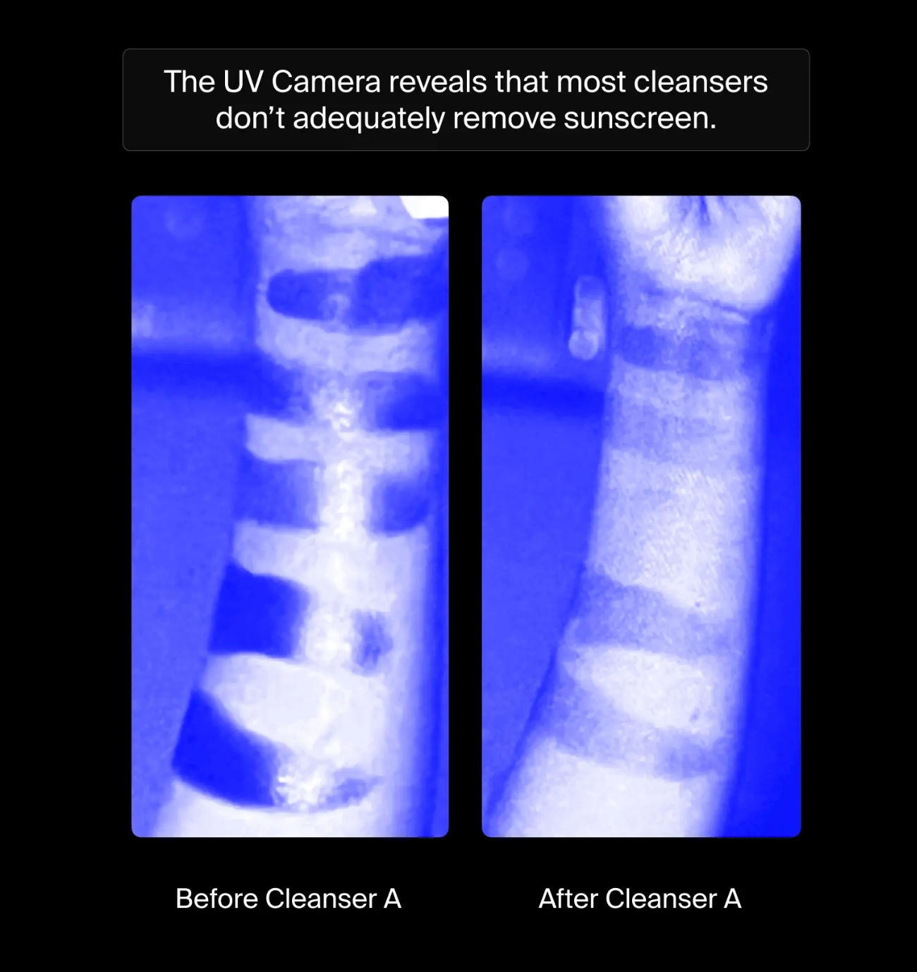 Comparison of sunscreen removal before and after using Cleanser A with a UV camera.